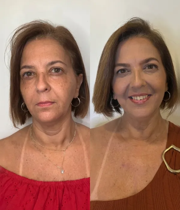 Resultado de tratamento corporal antes e depois na FEMME Clinic