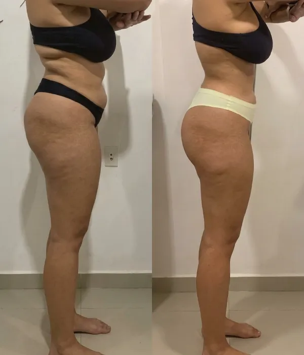 Resultado de Criomodelagem antes e depois na FEMME Clinic