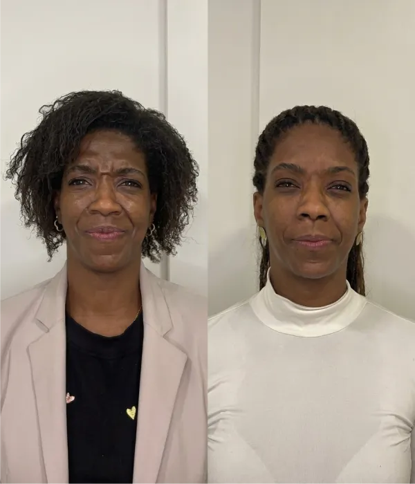 Resultado de Body Sculpture antes e depois na FEMME Clinic