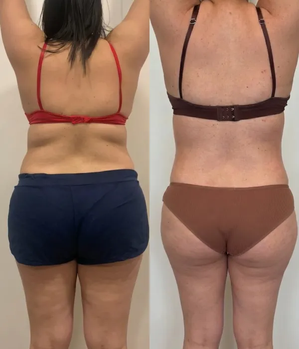 Resultado de protocolo estético antes e depois na FEMME Clinic
