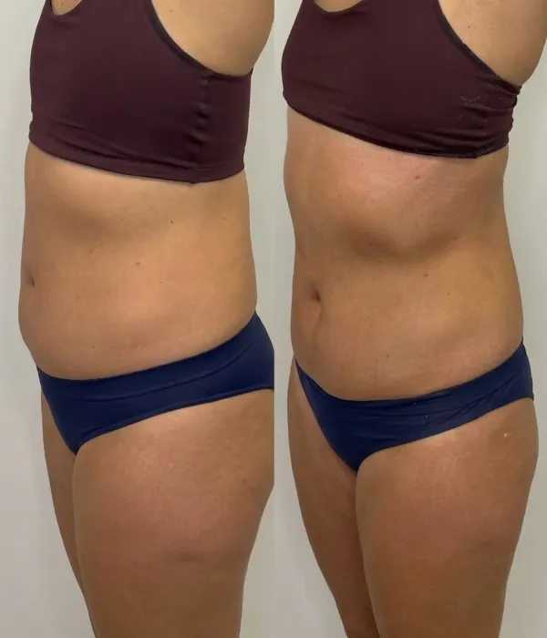 Resultado de contorno corporal antes e depois na FEMME Clinic